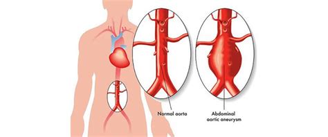 Endo Vascular Repair Of Abdominal Aortic Aneurysm Is Safe