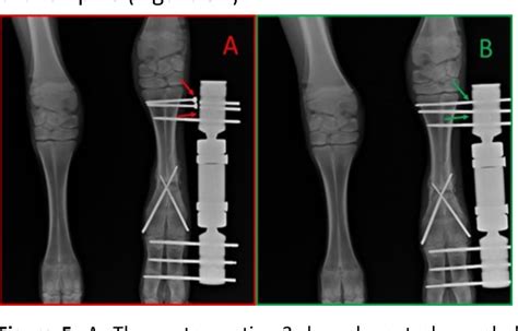 Figure From Use Of A Dynamic Axial External Fixator Combined With