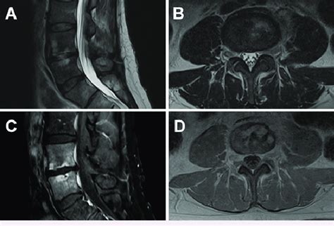 MRI Sequences Of Known L4 5 Discitis Osteomyelitis A And B T2