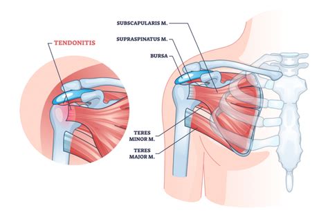 Shoulder Tendonitis: Symptoms, Causes, Treatment, and Prevention ...