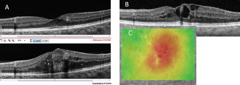 Identifying Diabetic Retinopathy Biomarkers With Oct Optometric Management