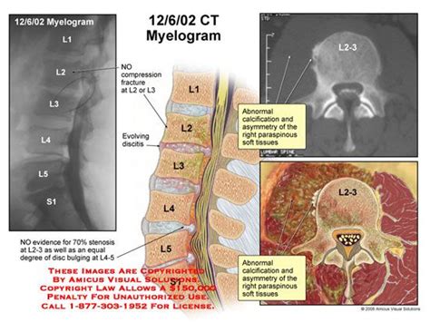 Myelogram Medical Illustration Radiology Technologist Medical