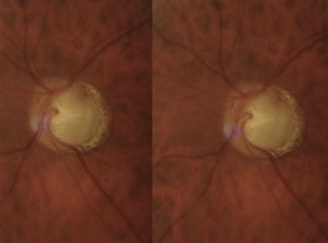 Optic Disc Hemorrhage What Next