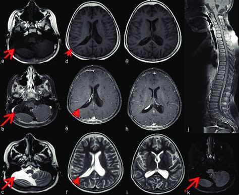 (a-c) Right posterior fossa arachnoid cyst (red arrow) which is leading ...