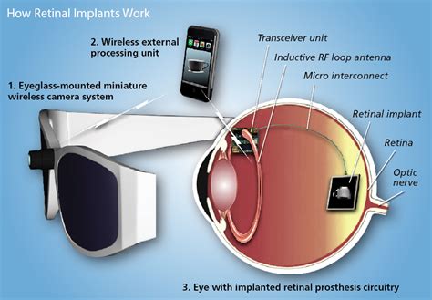 Retinal Implants Get An Upgrade Discover Magazine