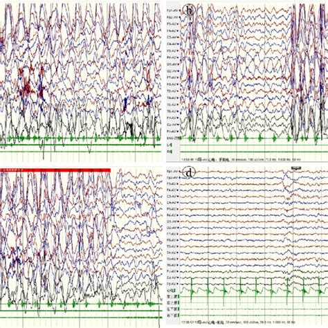 EEG Results Of Case 1 A Before Treatment Interictal Sleep VEEG