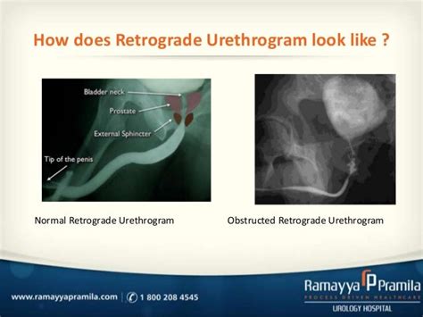 Retrograde Urethroscopy