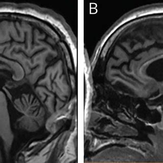 T1-weighted sagittal brain MRI | Download Scientific Diagram