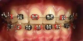 Red and Black Braces to Express Your Unique Orthodontic Style