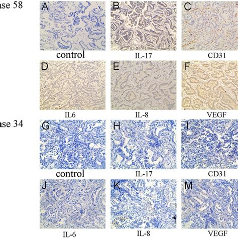 Expression Of Cd31 Il 17 Il 6 Il 8 And Vegf Protein In Human Lung Download Scientific