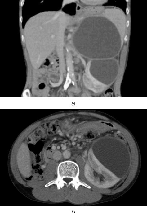 Figure 1 From A Case Of Renal Subcapsular Cyst Successfully Treated