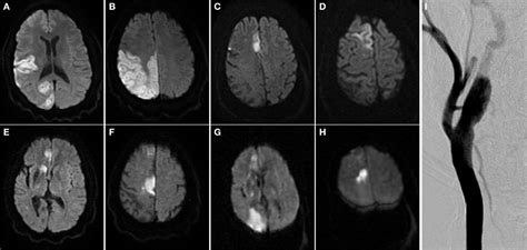 Frontiers Recurrent Embolic Strokes Of Undetermined Source In A Patient With Extreme