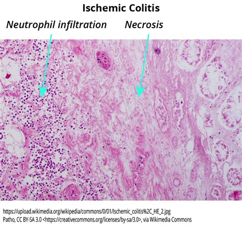 Clinical Pathology Glossary: Colitis | ditki medical & biological sciences