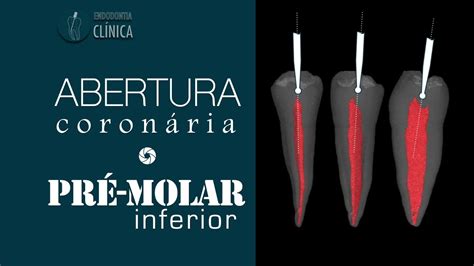 Anatomia e abertura coronária do Pré Molar Inferior YouTube