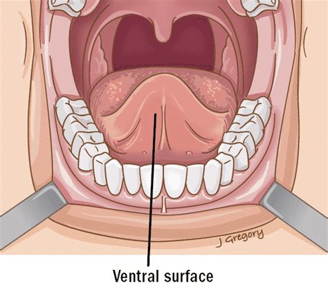 Tongue Cancer Anatomy Thanc Guide