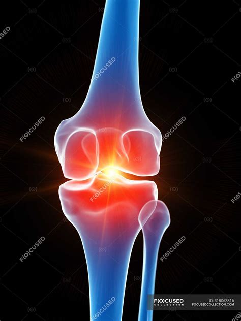 Human anatomy of knee pain, conceptual computer illustration. — femur ...