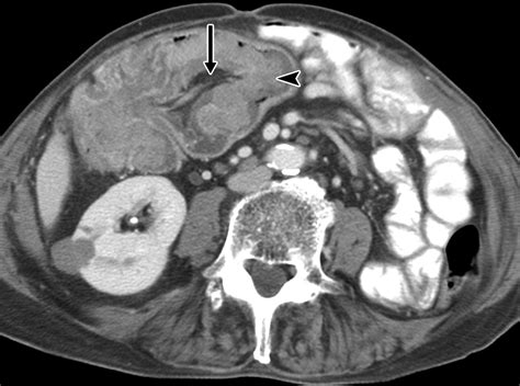 Colonic Intussusception Clinical And Radiographic Features Ajr