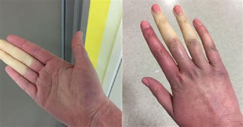 What is Raynaud's disease? The disorder that causes white or blue ...