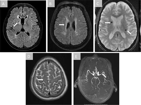 Incidental findings on brain MRI. Arrows indicate the abnormalities in ...