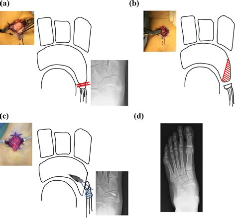 Zadek Procedure 100% Genuine | www.bharatagritech.com