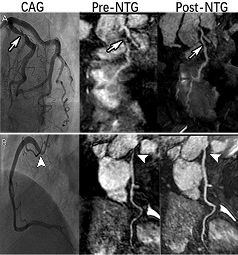 Applying Nitroglycerin At Coronary Mr Angiography At T Diagnostic