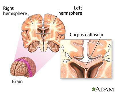 Aicardi syndrome | UF Health, University of Florida Health