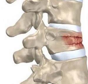 Osteoporosis | Vertebral Augmentation Treatment of Osteoporotic Fracture