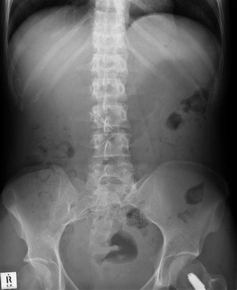 Swallowed Needles X Ray Photograph By Du Cane Medical Imaging Ltd Pixels