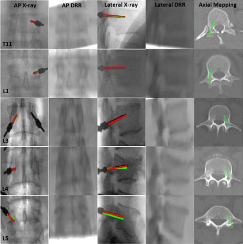 Clinical Validation Of Pedicle Screw Trajectory Registration Red And