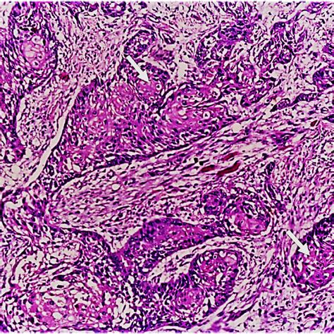 Showing Moderately Differentiated Squamous Cell Carcinoma Hande ×100