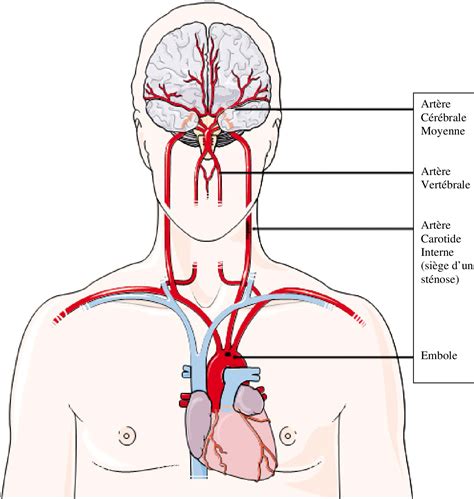 Figure 1.2 from L'infarctus cérébral artériel du nouveau-né à terme ...