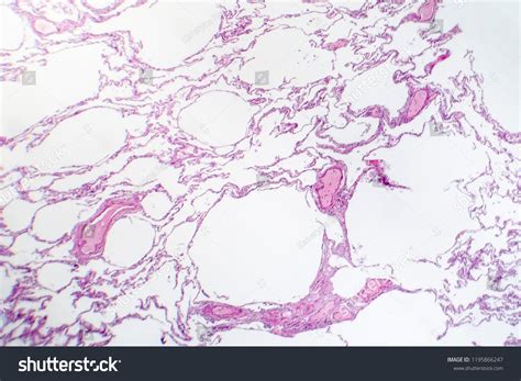 Diffuse Lung Emphysema Light Micrograph Photo Foto Stok