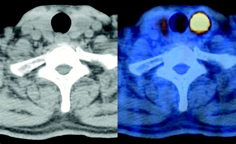 Focal Thyroid Lesions Incidentally Identified By Integrated 18f Fdg Pet