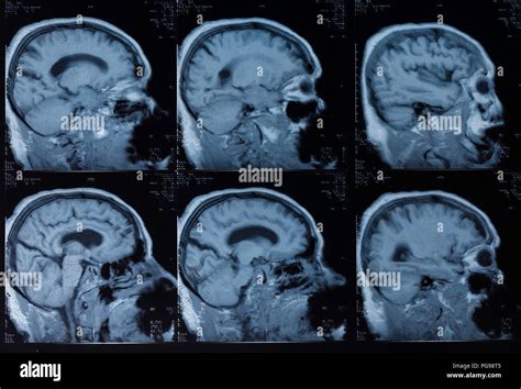 Human Brain Magnetic Resonance Imaging MRI Scans Stock Photo Alamy