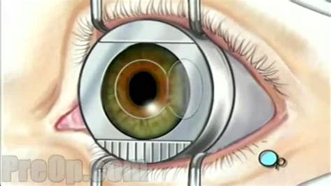 Laser Eye Surgery PreOp Patient Education Video Dailymotion