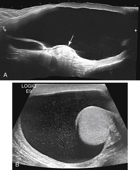 Scrotal Cysts Ultrasound