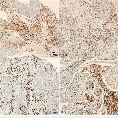 Heavy Membranous And Cytoplasmic Staining Of Tams By Cd163 Ihc Score Download Scientific