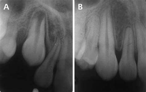 External Apical Root Resorption In Maxillary Incisors In Orthodontic