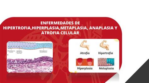 SOLUTION: Enfermedades de hipertrofia hiperplasia metaplasia anaplasia ...