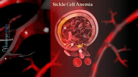 Sickle Cell Anemia Types Causes Treatment Medsurge India