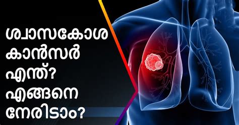 ശ്വാസകോശ കാൻസർ ഉണ്ടോ എന്ന് എങ്ങനെ തുടക്കത്തിൽ തിരിച്ചറിയാം എങ്ങനെ ഈ