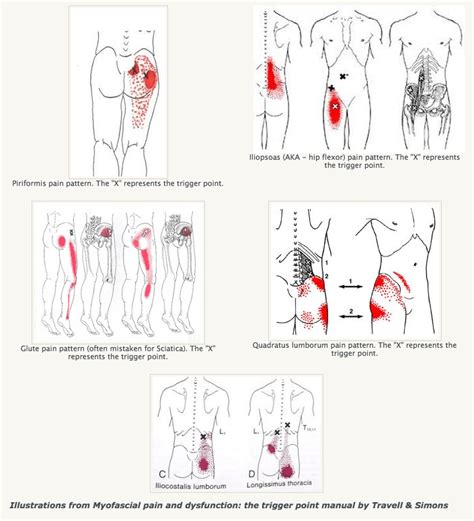 46+ Lower Back Pain Diagram - RachelleIsmail