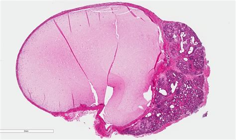 Mucocele Histology