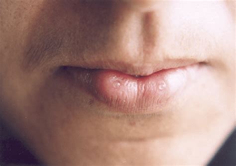 Bilateral Symmetrical Lower Lip Pits With Saliva Secretion Download