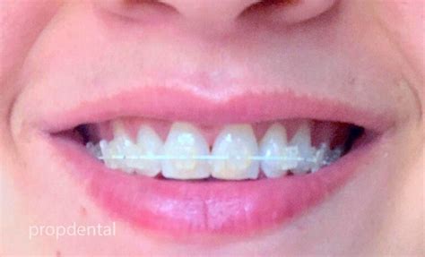 Ventajas De Los Brackets De Porcelana En Barcelona Y Madrid