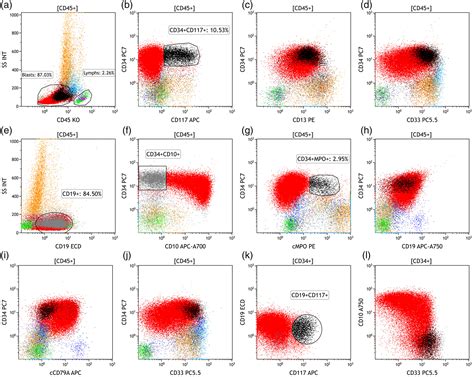 Lymphoid Blasts With Aberrant Myeloid Marker Expression And BCR ABL1