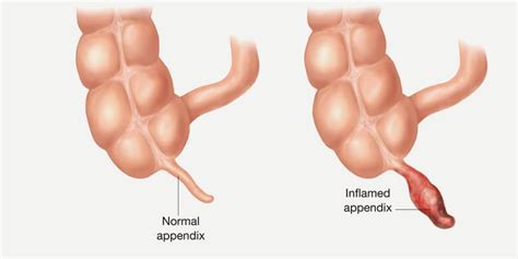 Appendix Facts Functions Of Appendix Location And Pictures