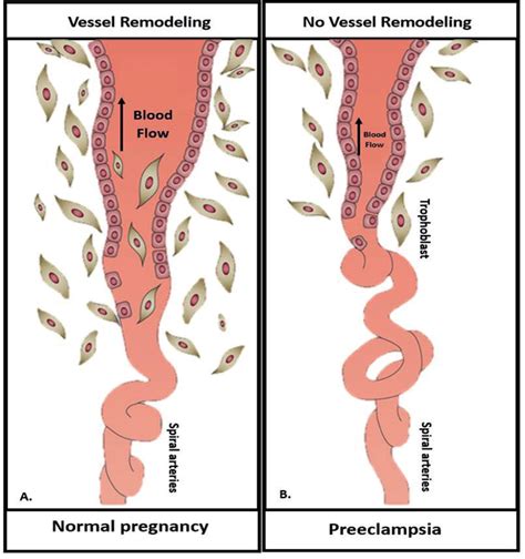 A Normal Pregnancy Uterine Spiral Arteries Are Wide Open And Remodeled