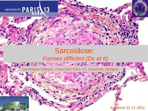 PPT Sarcoïdose pulmonaire sévère DOKUMEN TIPS