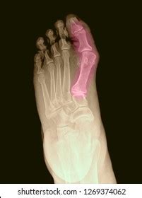 Fracture Bones Foot Stock Photo 1269374062 | Shutterstock